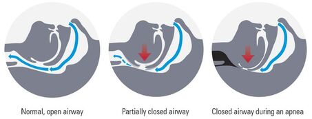 snoring-and-sleep-apnea-diagram