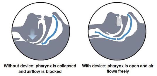 dental-device-sleep-apnea-treatment-1