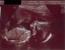 pregnancy_and_osa