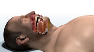 Obstructed_Airway.jpg